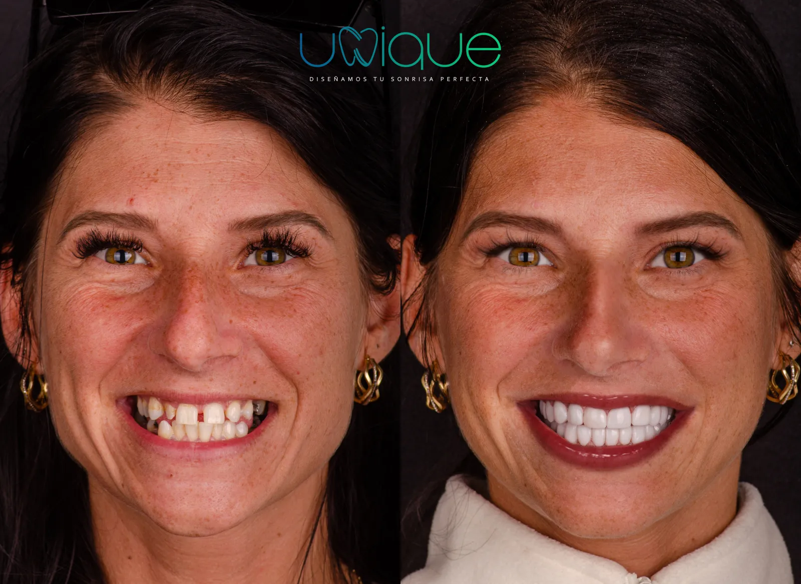 Resultado dental antes y después 2